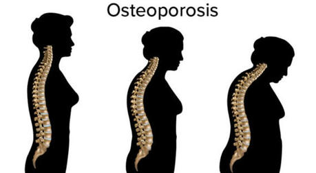 Preventing Osteoporosis: Daily Habits for Stronger Bones